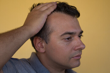 Obraz premium Image of a man showing the onset of hair loss and the principle of receding hairline. Possible causes and remedies for hair loss 
