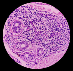 Skin tissue biopsy: Lichen planus. show skin tissue, hyperplastic squamous epithelium and subepithelial band like infiltration of lymphocytes. T-cell mediated autoimmune disorder.