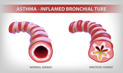 The illustration shows two parts of the bronchi, one normal and the other bronchitis and filled with sputum. use in medical and educational - obrazy, fototapety, plakaty
