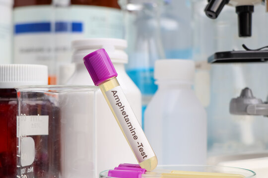 Urine samples for testing Amphetamines in the laboratory