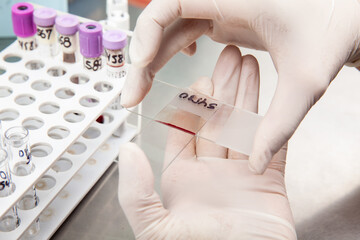 Scientist preparing a bone marrow smear in the laboratory. Blood smear.