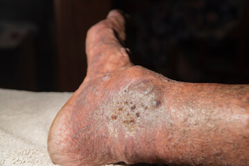 Caucasian man with thrombosed varicose veins on the back of his right foot.