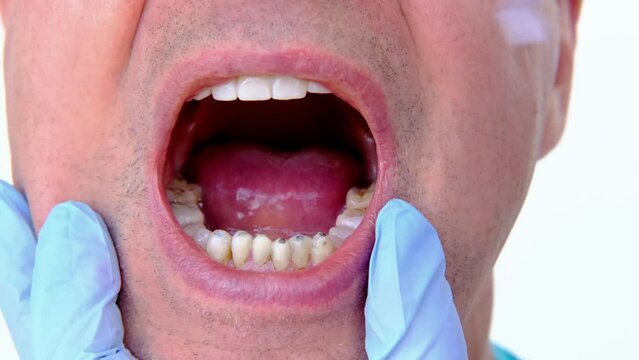 close-up of mature man, senior 60 years in dental office, open mouth, teeth with malocclusion and heavily worn enamel, doctor examines oral cavity before prosthetics, concept dental treatment