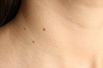 Fototapeta premium Closeup view of woman's body with birthmarks