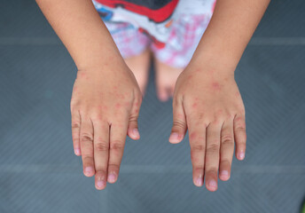 Rash on the hands of the Hand foot and mouth disease. Hand-foot-and-mouth disease is most commonly...