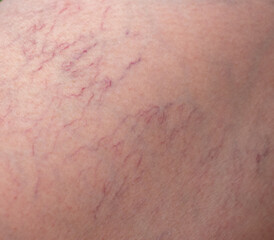 Fototapeta premium Veins on a woman's leg.