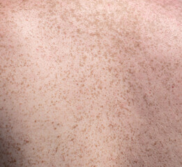 Freckle on the back of a man.