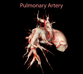 CTA pulmonary arteries 3D.