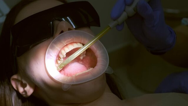 Dentist collects salivas with a saliva ejector in woman's oral cavity. Cure in dentistry. Preparing teeth for installing ceramic veneers and crowns. Treatment by an orthodontist, prosthetics concept.