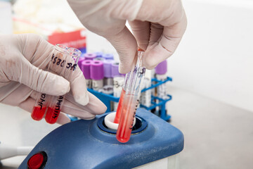 Scientist using a vortex to mix contents in a test tube. Scientist preparing bone marrow samples...