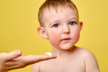 Mother smears allergy cream on face of toddler baby, studio yellow background. Close-up portrait of a cute baby and woman hand with cream Kid aged one year and two months - obrazy, fototapety, plakaty