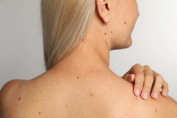 Closeup of woman`s body with birthmarks on light grey background, back view