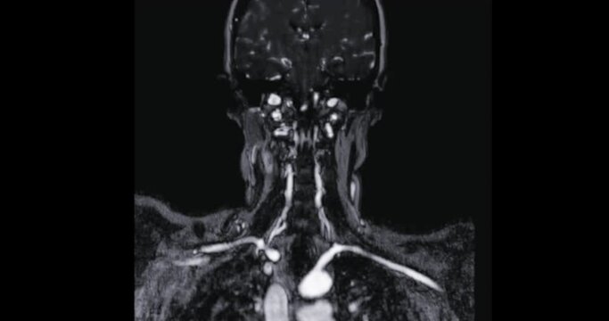 MRA Brain or Magnetic resonance angiography of the brain AXIAL view showing cerebral artery .