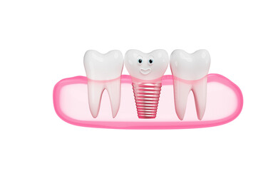 3d gum with dental implant isolated. 3d render illustration