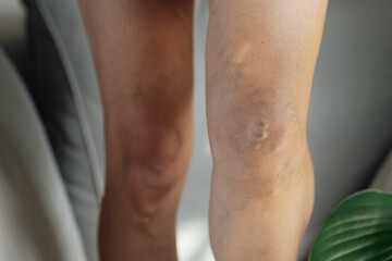 Woman with tired painful and spider varicose veins at home. Healthcare problem, thrombophlebitis issue. laser surgery recovery and prevention, Compression Stockings Thigh
