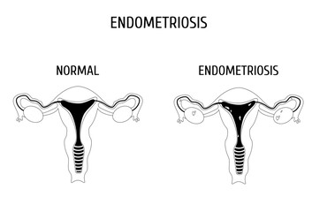 Female genital organs with and without endometriosis outline. Infographics.