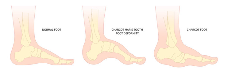 The Charcot foot anatomy painful and diabetic gout disease sores leg and Pes Cavus arches of Cavovarus hammer toes