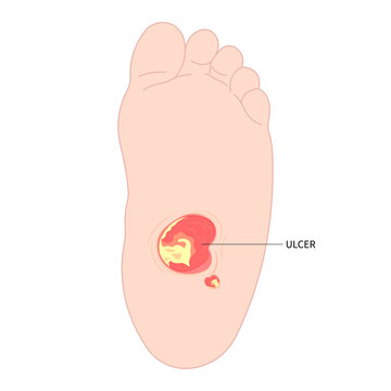 Diabetic foot with Charcot painful gout disease sores leg and Pes Cavus arches of Cavovarus hammer toes