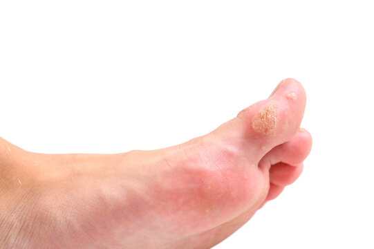 Large wart on toe isolated on white background. Close-up.