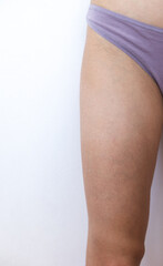 venous mesh on the legs of a young woman, a leg with an uneven tan