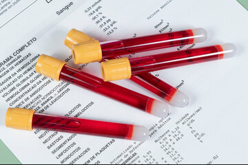 vacuum tube with blood for laboratory test on written result