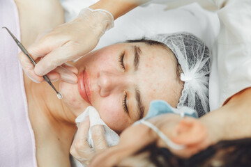 Obraz na płótnie Canvas Cosmetic facial cleansing procedure for a young woman using a spoon uno. acne treatment. mechanical cleaning of the facial skin.