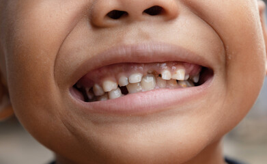 Portrait of the boy smiled and showing new small teeth from gum and bad damaged tooth in the mouth....