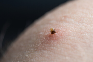 Sucking tick Macro photo on human skin. Ixodes ricinus. Bloated parasite bitten into pink irritated epidermis. Small red drops. Dangerous insect mite. Encephalitis, Lyme disease infection