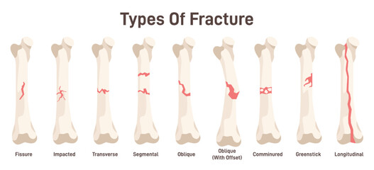 Types of bone fractures. Body injury, partial or complete break