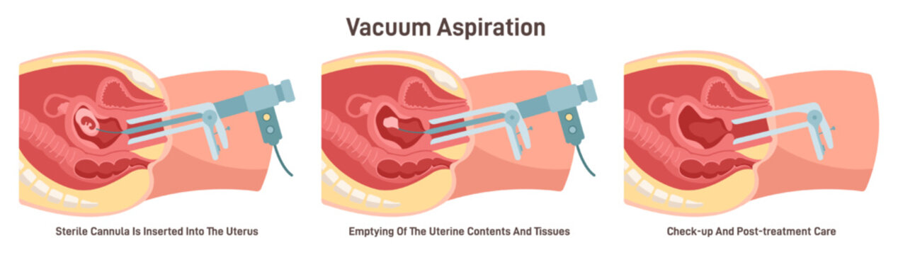 Vacuum aspiration set. Embryo or fetus vacuum removing. First trimester