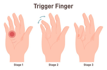 Trigger finger or finger lock. Disease causing pain, stiffness, and a sensation - obrazy, fototapety, plakaty