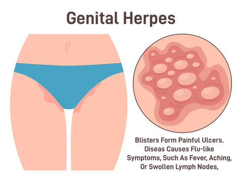 Genital herpes. Sexually transmitted infection, causing herpetic sores