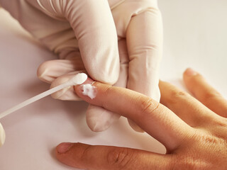 Burrs on the boy's finger are treated with ointment.