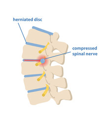 Sciatic nerve pinching concept. Pain in lumbar spine between vertebrae. Hernia of spinal cord. Design element for anatomy or education books. Cartoon flat vector illustration on white background