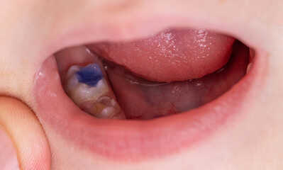 Colored blue filling in a child's tooth after caries treatment. Modern medicine with colorful fillings for children.
