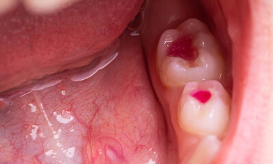 Child's mouth with multi-colored red dental fillings after dental treatment in pediatric dentistry....