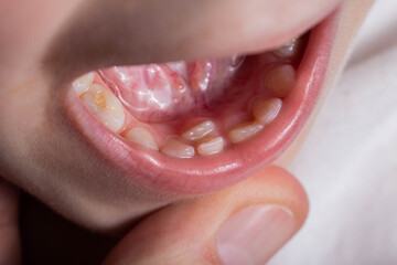 A permanent molar in a child grows second row. Incorrect growth of molars or polyodontia in...