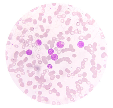 Acute Myeloid Leukemia (AML) Cells Analysed By Light Microscope