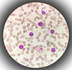 Microscopic image showing Chronic myeloid leukaemia (CML) is a type of cancer, all stage of...