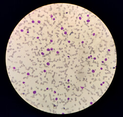 Microscopic image showing Chronic myeloid leukaemia (CML) is a type of cancer, all stage of...