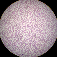 Acute thrombocytopenia and leucocytopenia. Close up Micrograph of dengue virus fever patient at...