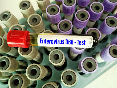 Blood sample for Enterovirus D68 test. It's a member of the Picornaviridae family, an enterovirus. First isolated in California in 1962 