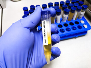 Urine specimen for doping drugs test of marijuana and cocaine. To detect illegal drugs in human...