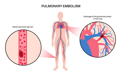 Pulmonary embolism disease - 533626046