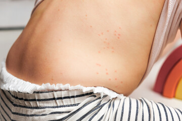 Back of Small Child with Red Rash. Baby with Red Spots Blisters on the skin. Close up of Painful...