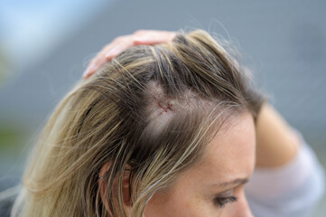 Head in a close-up with a fresh surgery scar