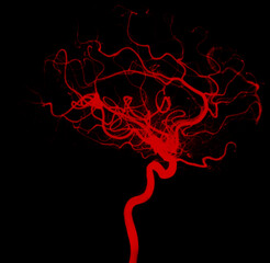 cerebral angiogram for neurology concept.