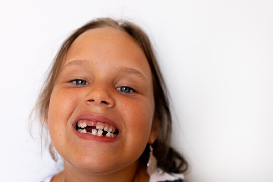 Adorable girl with open toothless mouth with temporary milk spacing crowding teeth in white isolated studio. Orthodontic practice, dental work with cross bite and overjet. Caries decay. Copy space