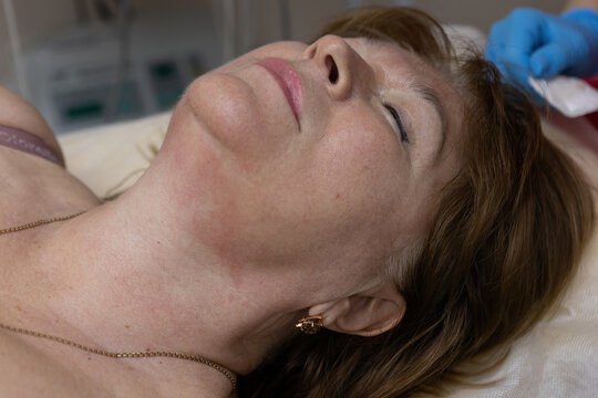 Correction of the second chin by injections of carbon dioxide by a cosmetologist woman aged
