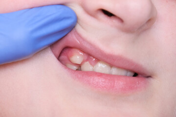 A 12 year old teeth with malocclusion close up, orthodontic problem and preparing for treatment,...